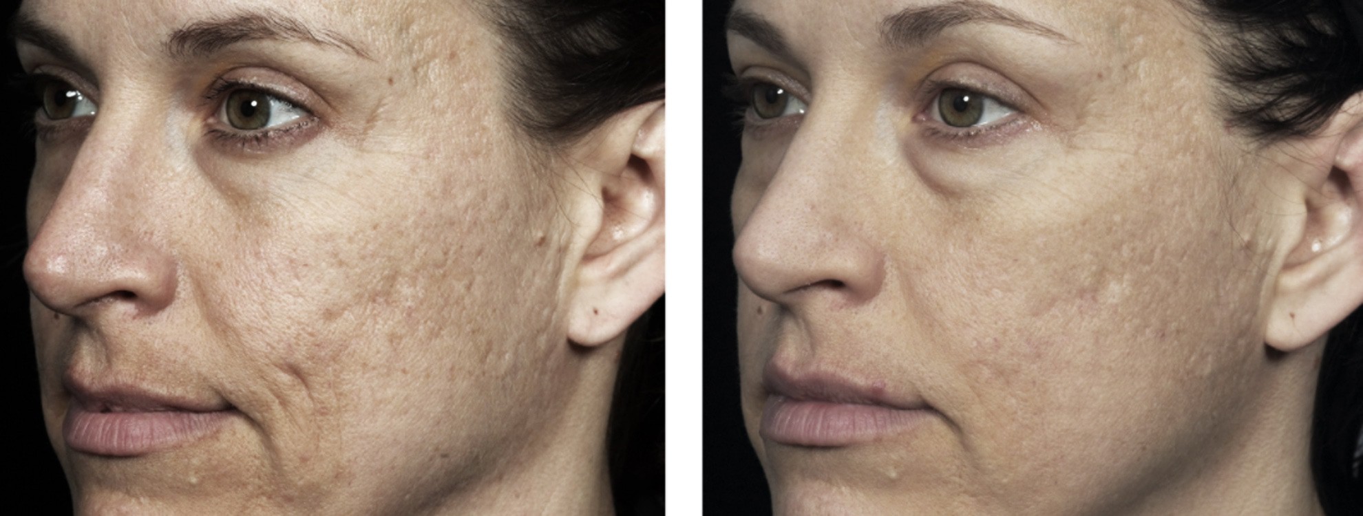 Laser Hair Removel and Fraxel Laser in Abu Dhabi