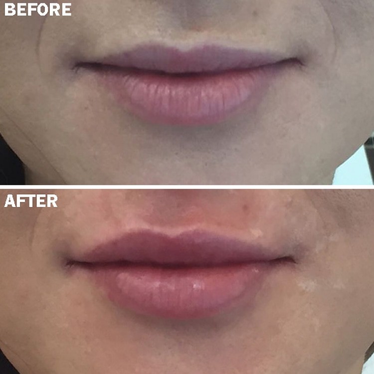 abu dhabi lipfiller before after c