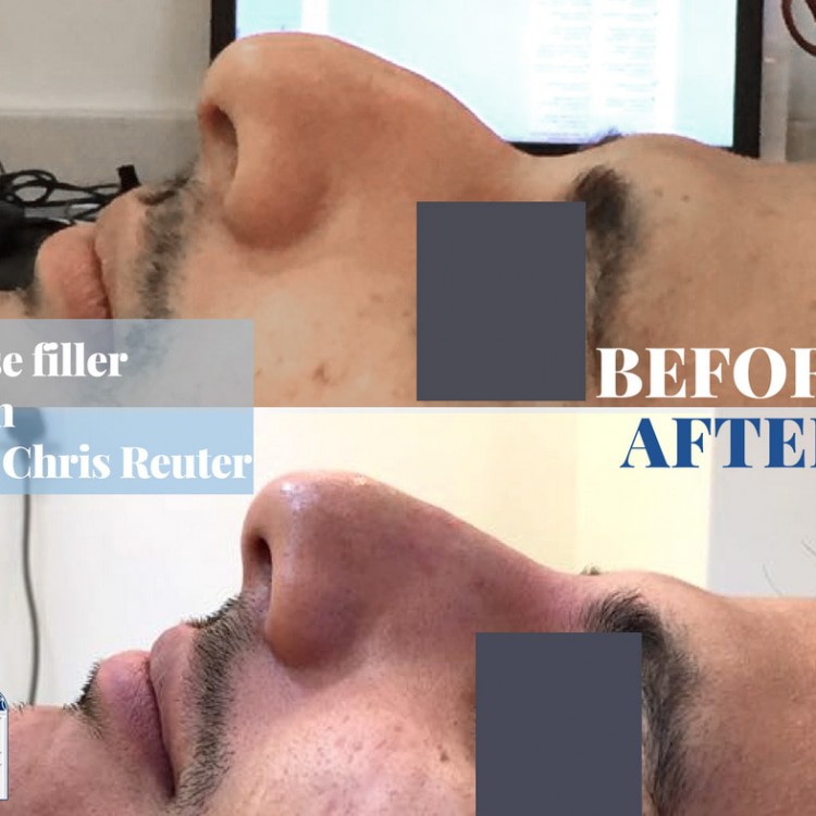 abu dhabi nose correction filler