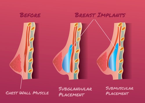 Breast Surgery in Abu Dhabi