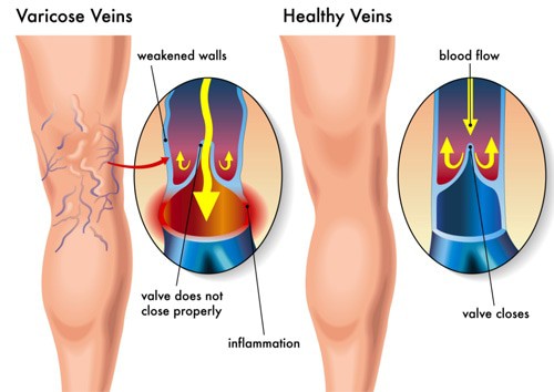 Varicose Veins Treatment - German Surgeon in Abu Dhabi